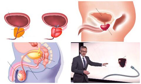 healthy and diseased prostate