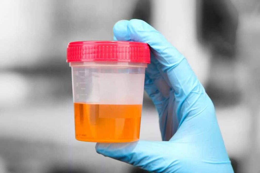 urine with blood in calcified prostatitis