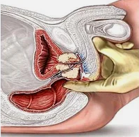 Massage Of The Prostate Gland